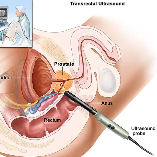 Prostate Ultrasound Test